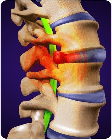 Effective Disc Bulge Treatment: Non-Surgical Solutions