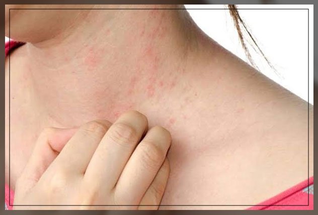 Dust Mite Allergy