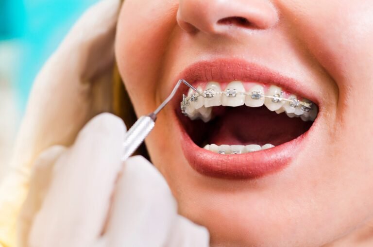 Aligners Braces