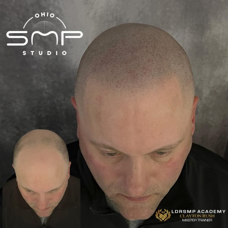 Scalp Micropigmentation: Confidence Restored